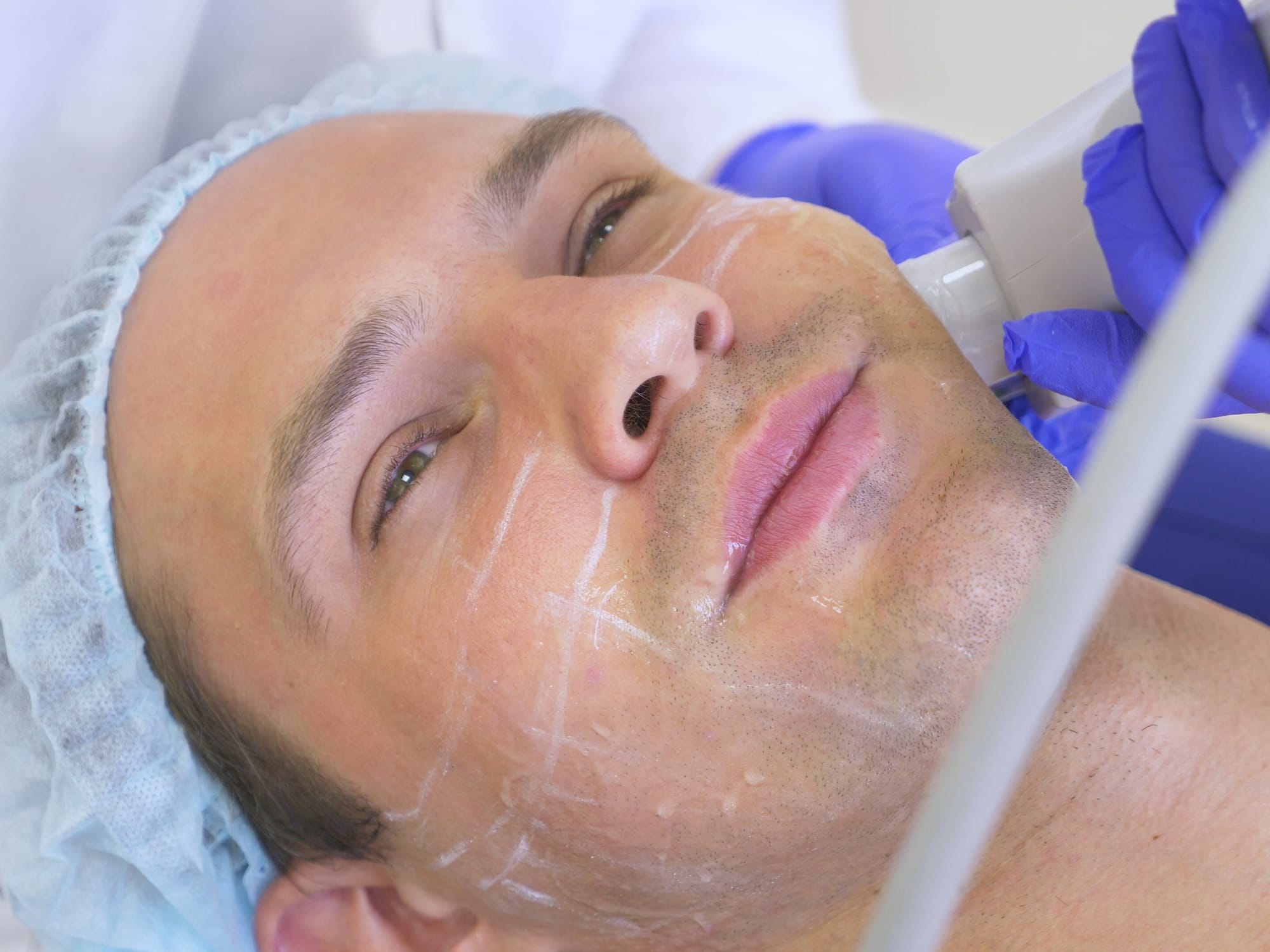 T-Shape 2 Nonsurgical Facelift